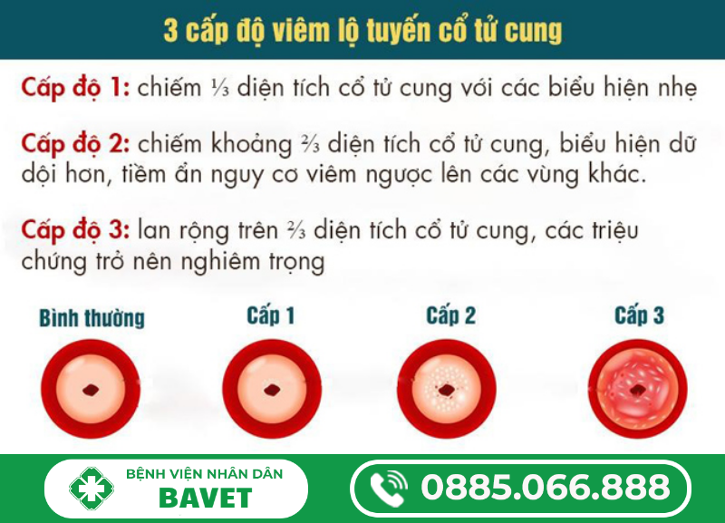 VIÊM LỘ TUYẾN LÀ GÌ?