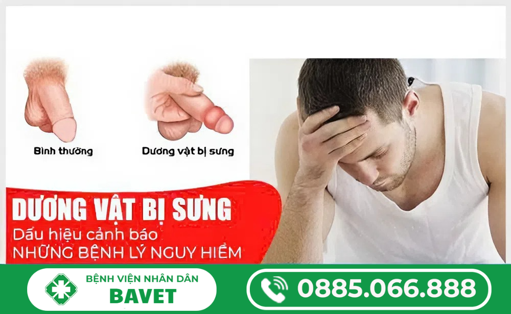 TÌM HIỂU VỀ SƯNG ĐAU DƯƠNG VẬT