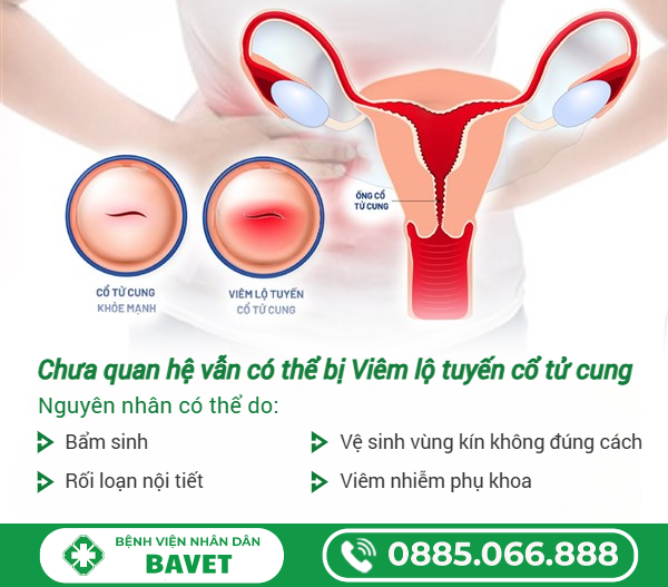 CHƯA QUAN HỆ CÓ THỂ BỊ VIÊM LỘ TUYẾN CỔ TỬ CUNG KHÔNG?