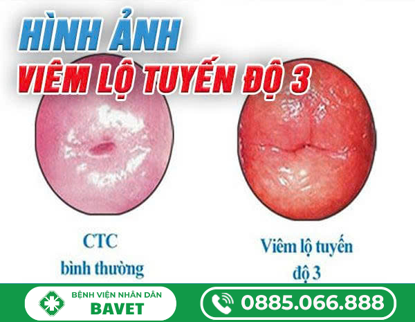 VIÊM LỘ TUYẾN CỔ TỬ CUNG CẤP ĐỘ 3 LÀ GÌ?