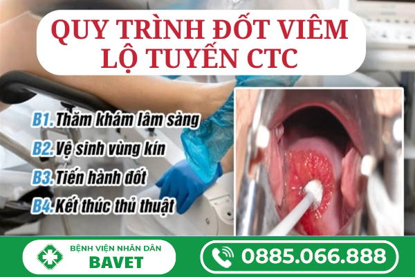 QUY TRÌNH ĐỐT VIÊM LỘ TUYẾN CỔ TỬ CUNG