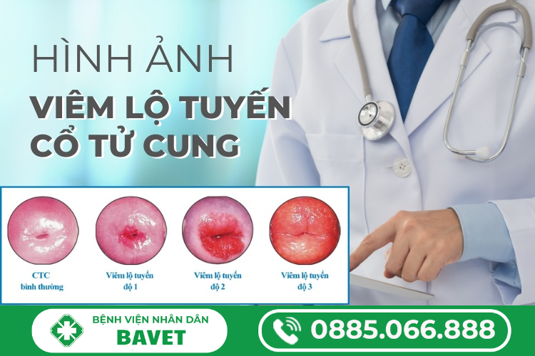HÌNH ẢNH VIÊM LỘ TUYẾN CỔ TỬ CUNG