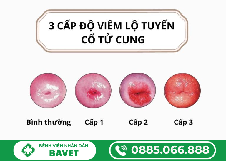 VIÊM LỘ TUYẾN 0.5CM – 3CM LÀ ĐỘ MẤY?