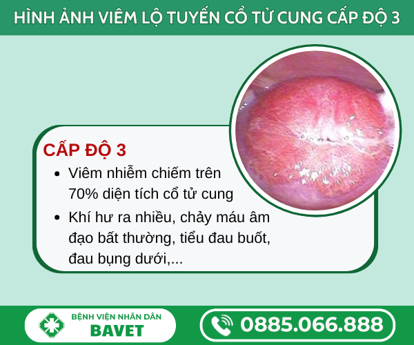 VIÊM LỘ TUYẾN DIỆN RỘNG LÀ GÌ?