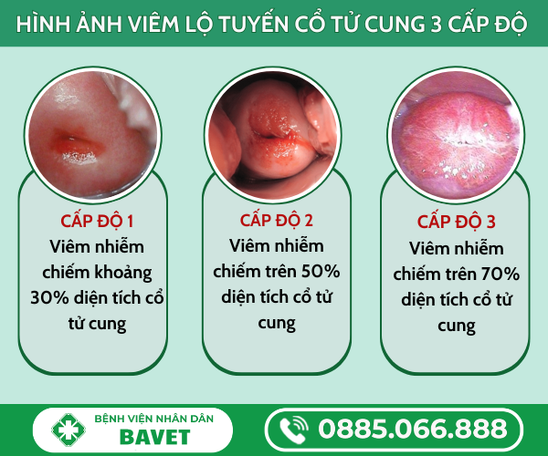 VIÊM LỘ TUYẾN MÔI TRÊN, MÔI DƯỚI