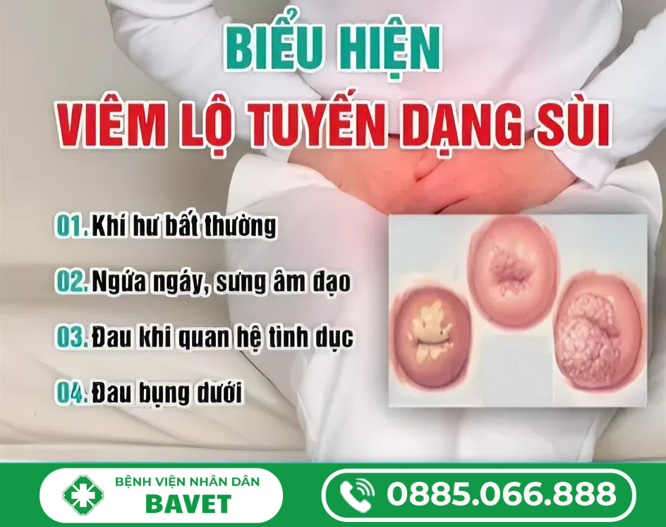 VIÊM LỘ TUYẾN DẠNG SÙI LÀ GÌ?