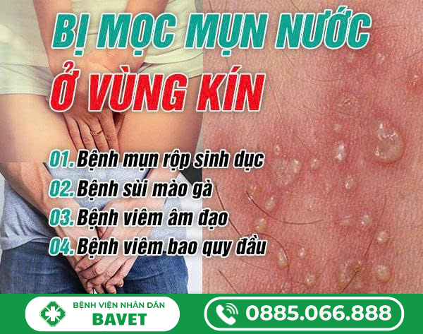 BỊ MỌC MỤN NƯỚC Ở VÙNG KÍN