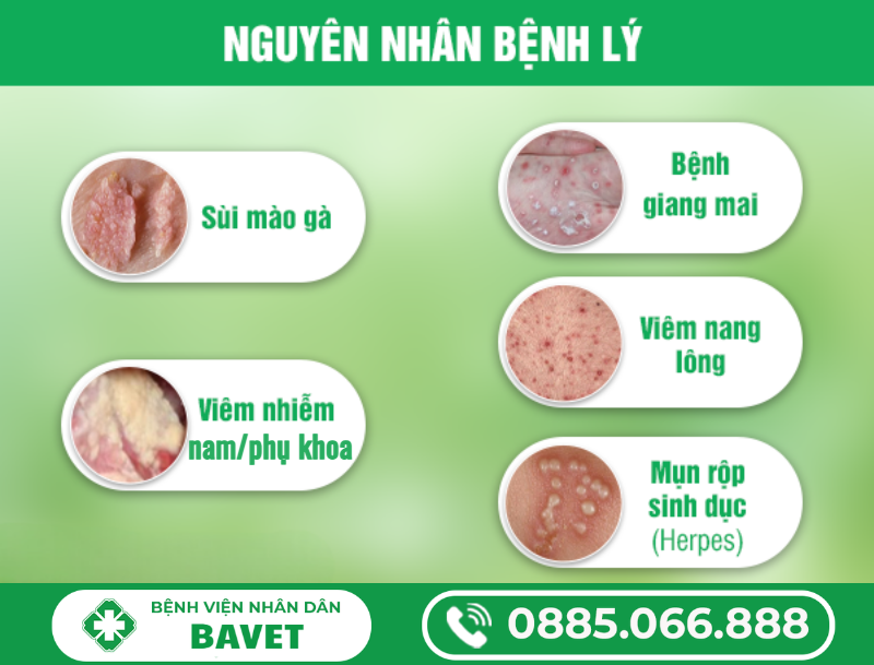 MỌC MỤN HẠCH Ở VÙNG KÍN