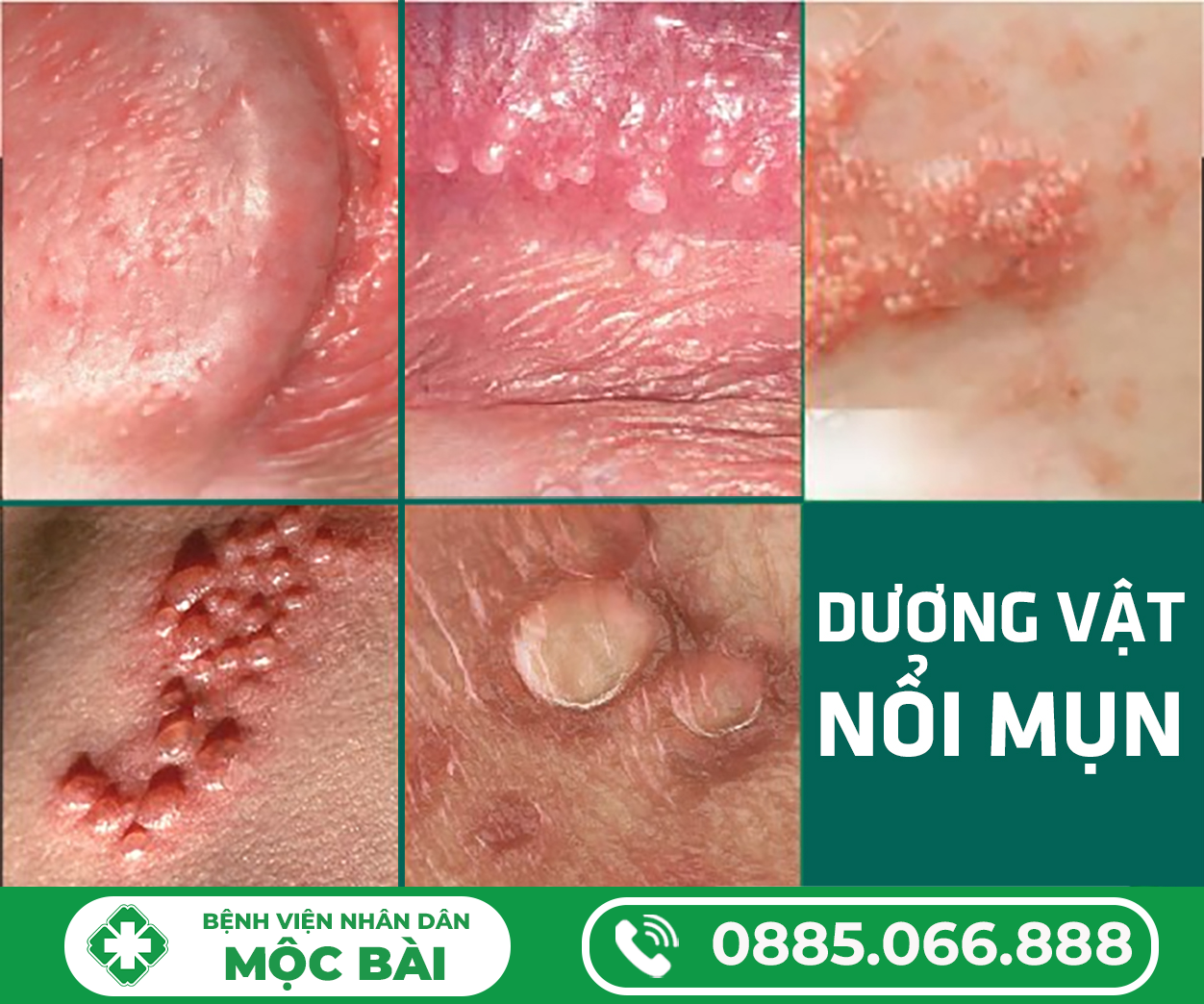 DƯƠNG VẬT NỔI MỤN MỦ