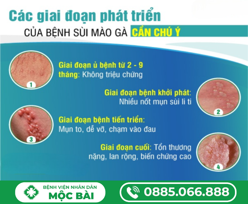 CÁC GIAI ĐOẠN CỦA BỆNH SÙI MÀO GÀ