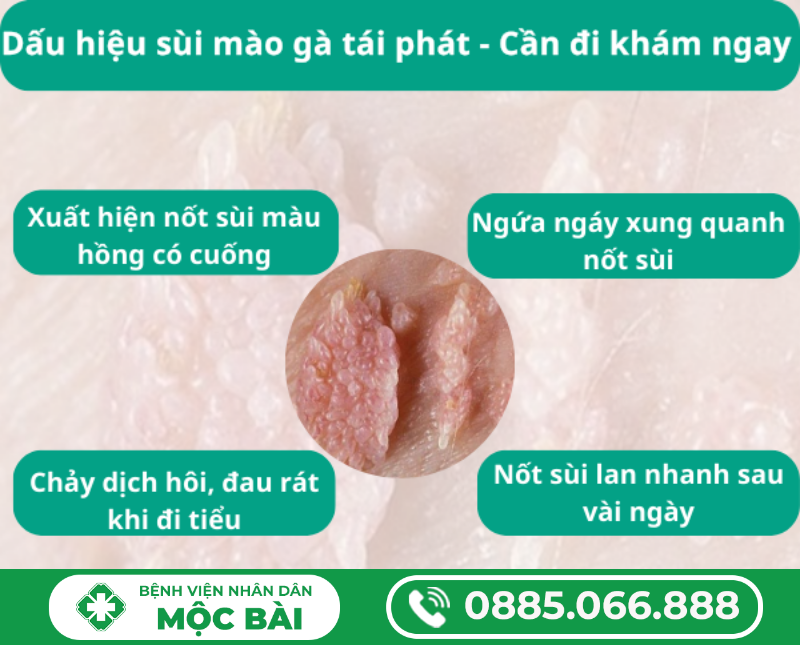 DẤU HIỆU BỆNH SÙI MÀO GÀ TÁI PHÁT