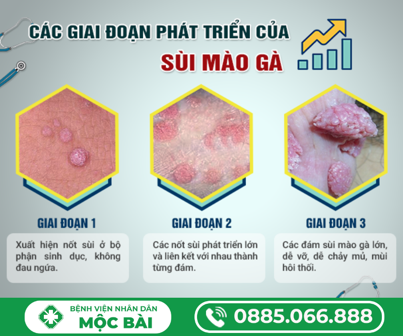 BỆNH SÙI MÀO GÀ PHÁT TRIỂN NHƯ THẾ NÀO?