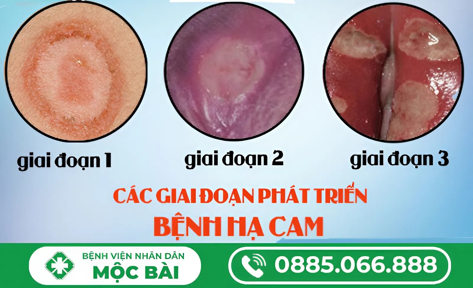 TÌM HIỂU VỀ BỆNH HẠ CAM MỀM 