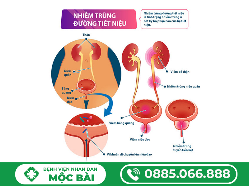 TÌM HIỂU VỀ BỆNH VIÊM ĐƯỜNG TIẾT NIỆU