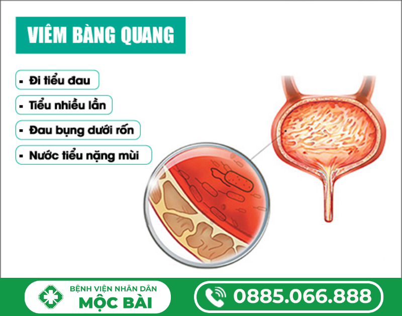 BỆNH VIÊM BÀNG QUANG MÃN TÍNH