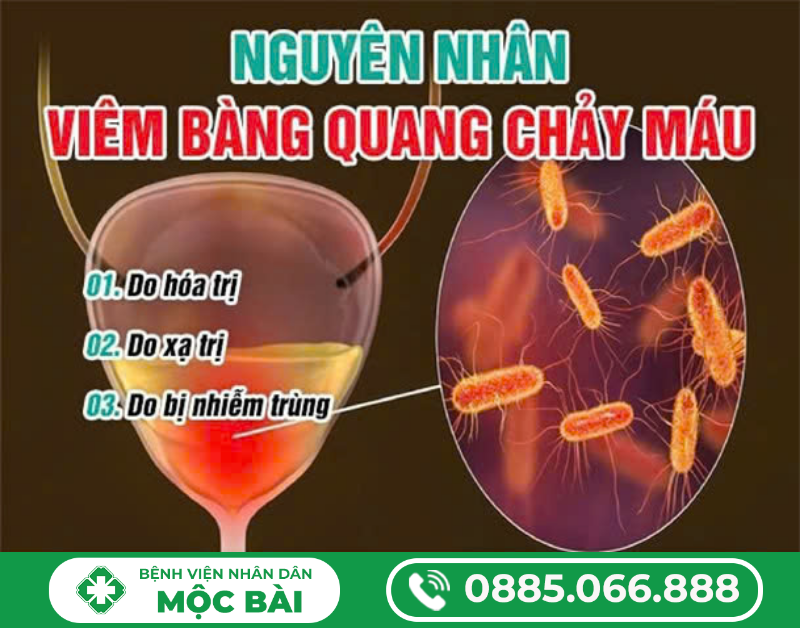 VIÊM BÀNG QUANG CHẢY MÁU