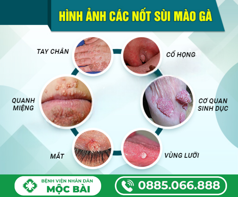 CÁC BỆNH DỄ NHẦM LẪN VỚI SÙI MÀO GÀ