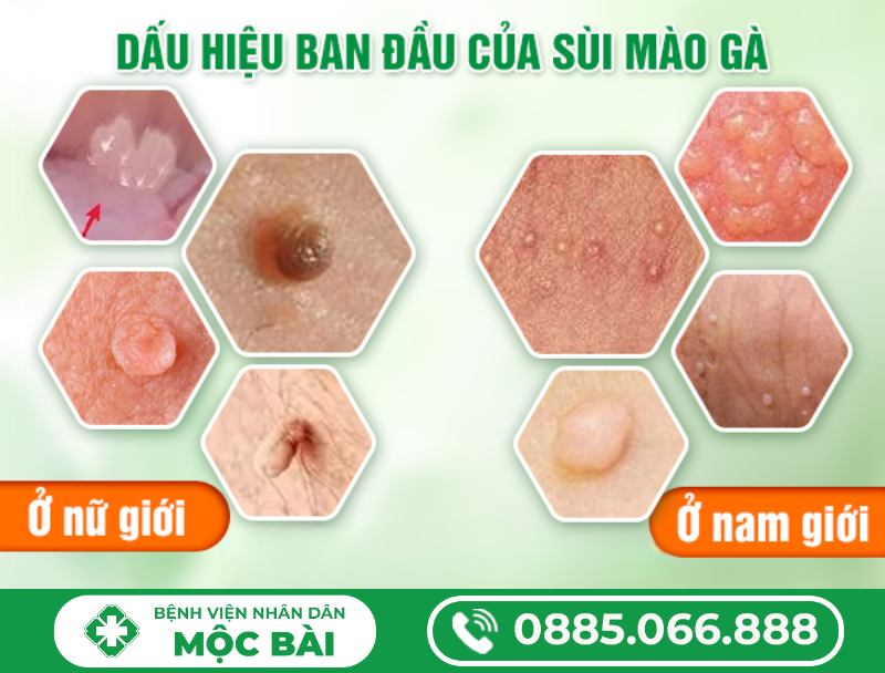 BIỂU HIỆN BAN ĐẦU CỦA BỆNH SÙI MÀO GÀ
