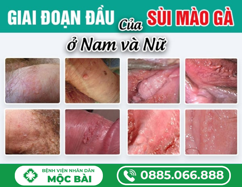 SÙI MÀO GÀ GIAI ĐOẠN 1 – BIỂU HIỆN BAN ĐẦU VÀ CÁCH NHẬN BIẾT SỚM