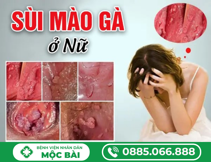 SÙI MÀO GÀ GIAI ĐOẠN NẶNG – BIỂU HIỆN, TIẾN TRIỂN VÀ BIẾN CHỨNG