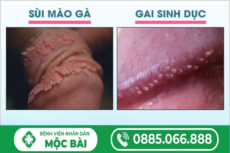 CÁCH NHẬN BIẾT SÙI MÀO GÀ VÀ GAI SINH DỤC