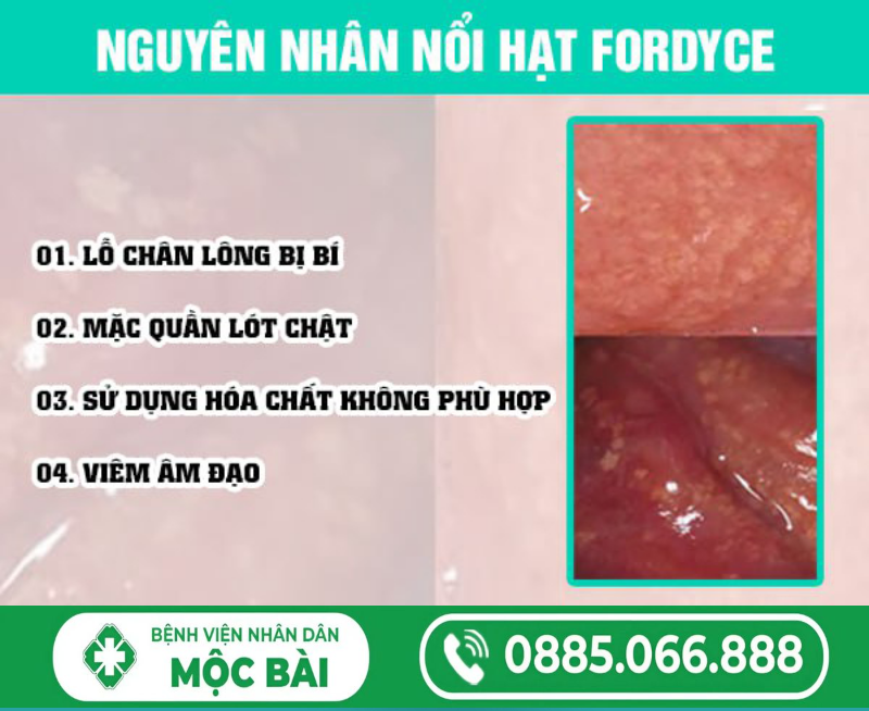CÁCH PHÂN BIỆT HẠT FORDYCE VÀ SÙI MÀO GÀ