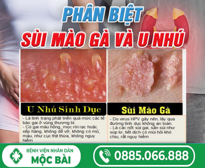 PHÂN BIỆT SÙI MÀO GÀ VÀ U NHÚ, U MỀM LÂY