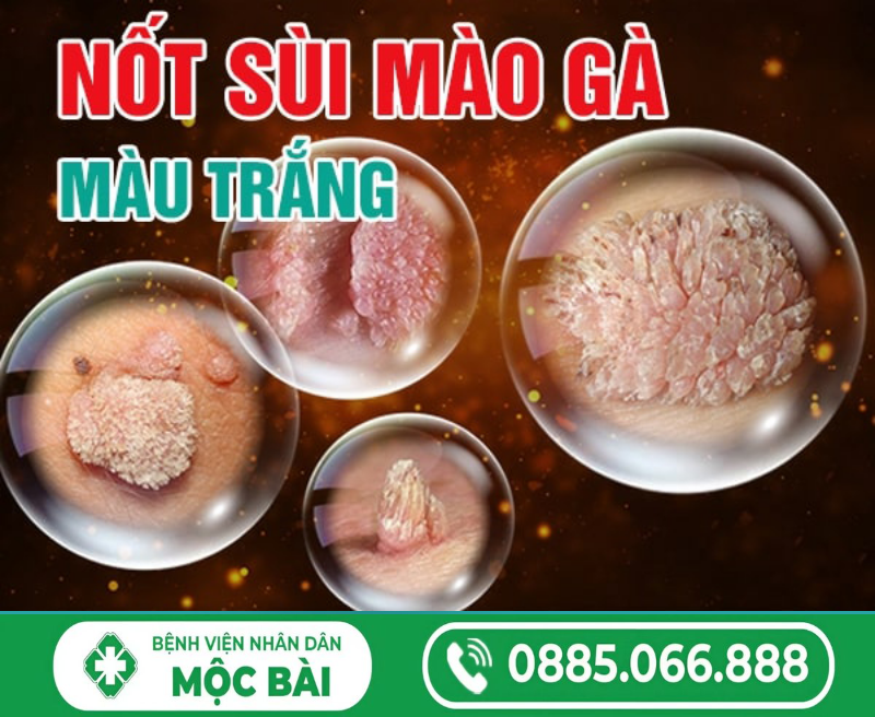 TÌM HIỂU NỐT SÙI MÀO GÀ MÀU ĐEN, MÀU TRẮNG