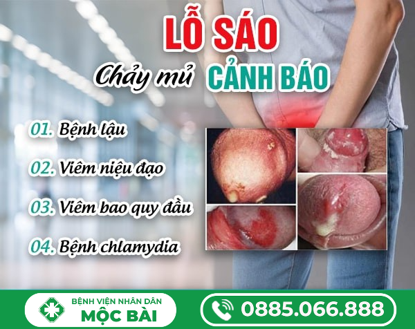 CHẢY MỦ LỖ SÁO Ở NAM GIỚI – DẤU HIỆU BẤT THƯỜNG CẦN THĂM KHÁM SỚM