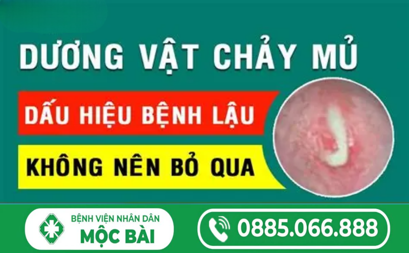 BỆNH LẬU CHẢY MỦ: MỨC ĐỘ NGUY HIỂM VÀ CÁCH ĐIỀU TRỊ