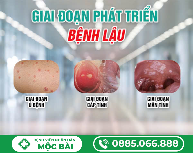 THỜI GIAN Ủ BỆNH LẬU Ở NỮ GIỚI