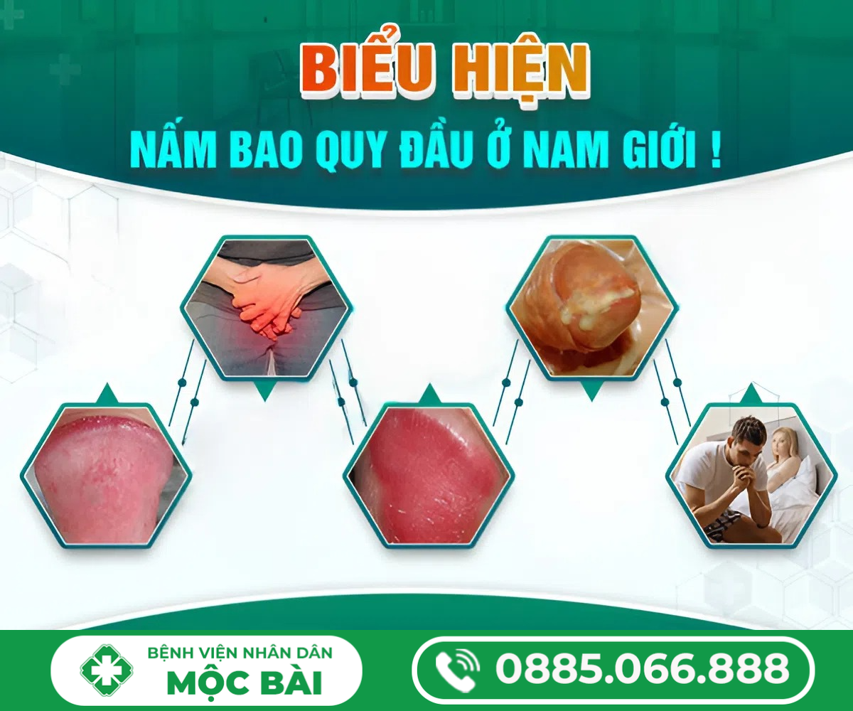 DẤU HIỆU NẤM BAO QUY ĐẦU
