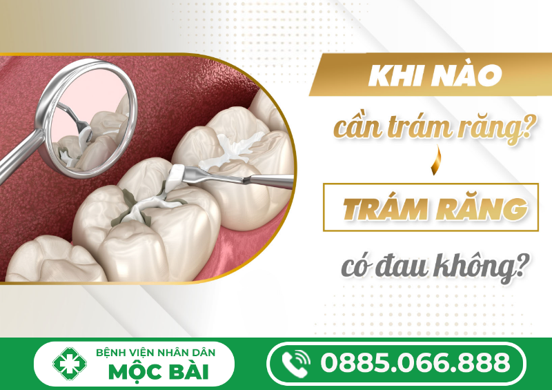 COMPOSITE TRÁM RĂNG LÀ GÌ? TÌM HIỂU CHI TIẾT TỪ A–Z