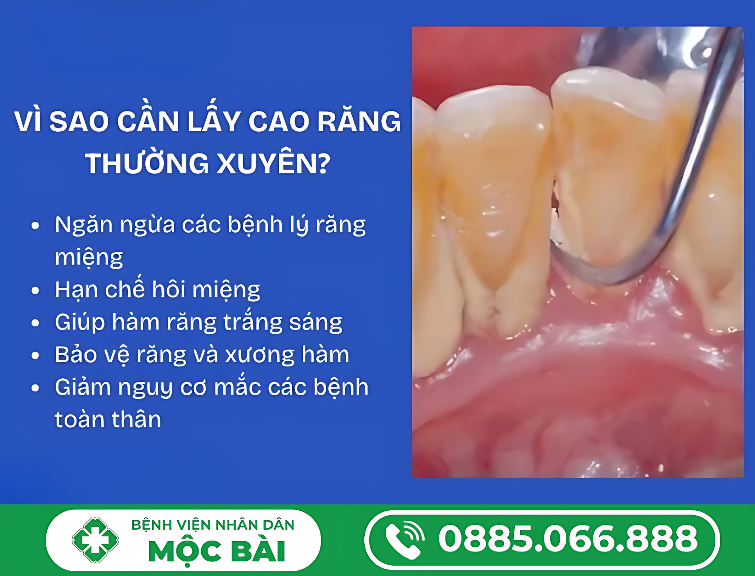 TẠI SAO PHẢI LẤY CAO RĂNG ĐỊNH KỲ?