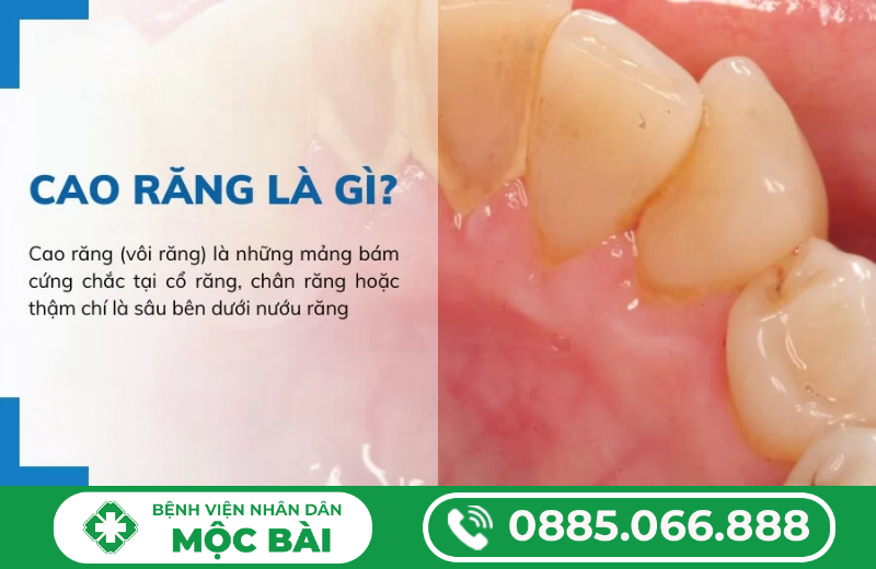 KHÔNG LẤY CAO RĂNG CÓ SAO KHÔNG?