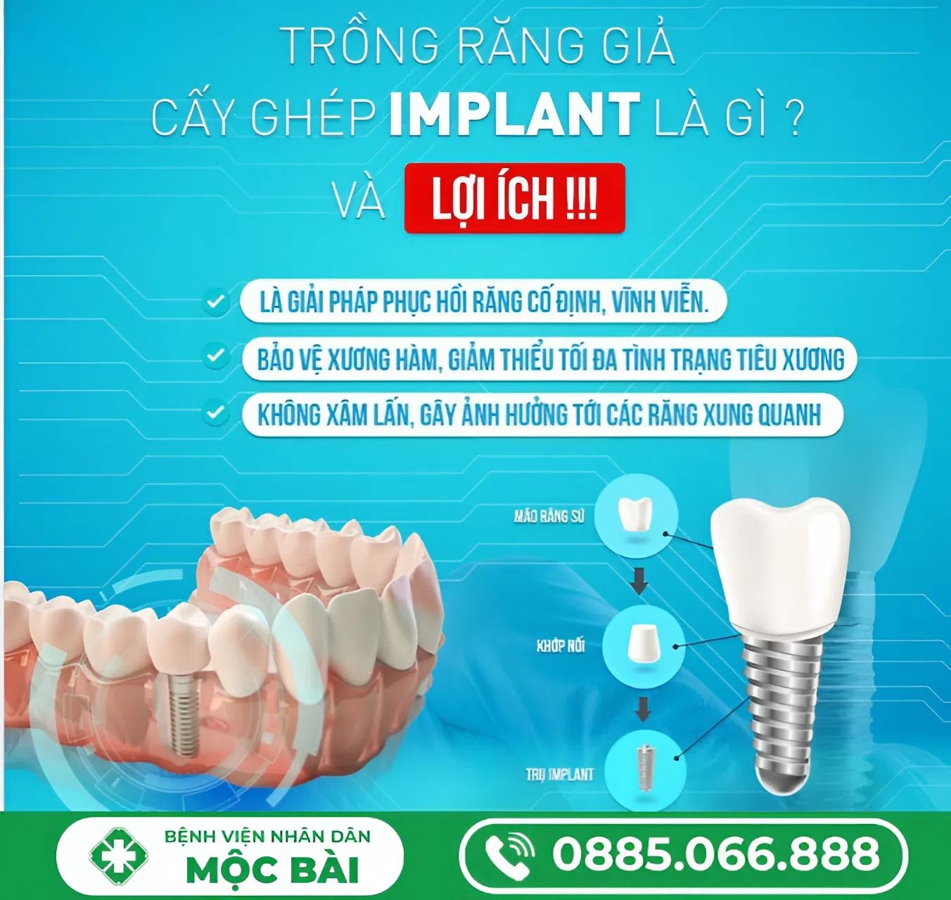 LÀM RĂNG SỨ MẤT BAO LÂU? QUY TRÌNH & THỜI GIAN CHI TIẾT