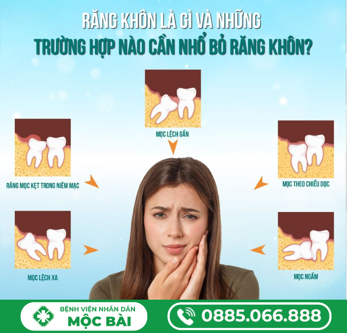 RĂNG HÀM CÓ NHỔ ĐƯỢC KHÔNG?