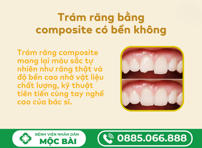 TRÁM RĂNG COMPOSITE CÓ BỀN KHÔNG?