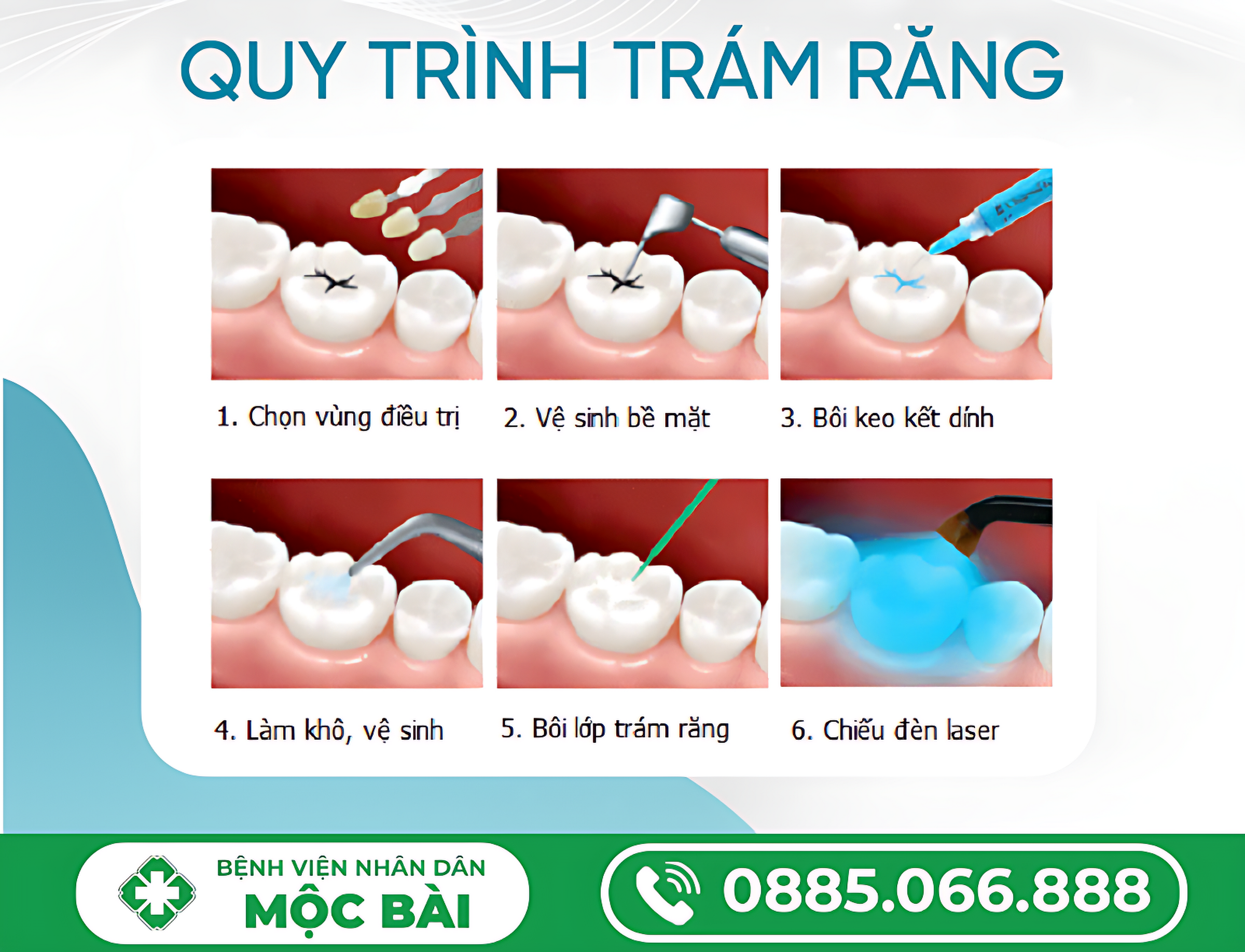 QUY TRÌNH TRÁM RĂNG BẰNG COMPOSITE