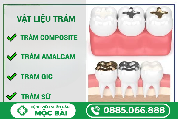 SO SÁNH TRÁM RĂNG COMPOSITE VÀ CÁC LOẠI KHÁC