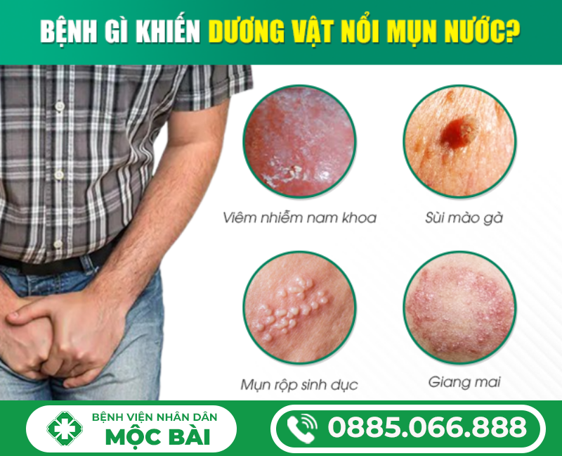 NỔI MỤN NƯỚC Ở BAO QUY ĐẦU