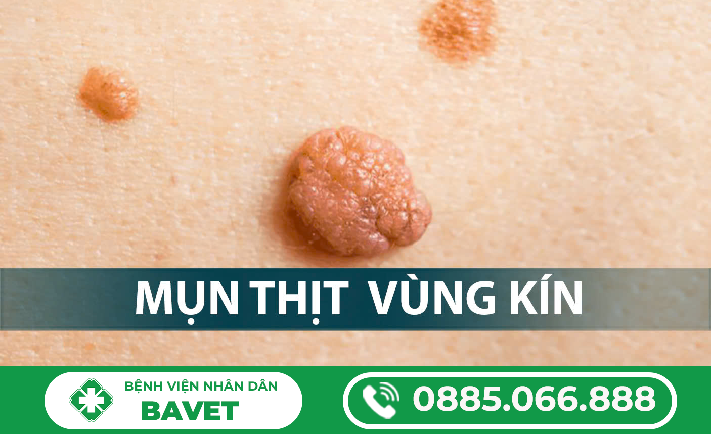 NỔI MỤN THỊT Ở BAO QUY ĐẦU