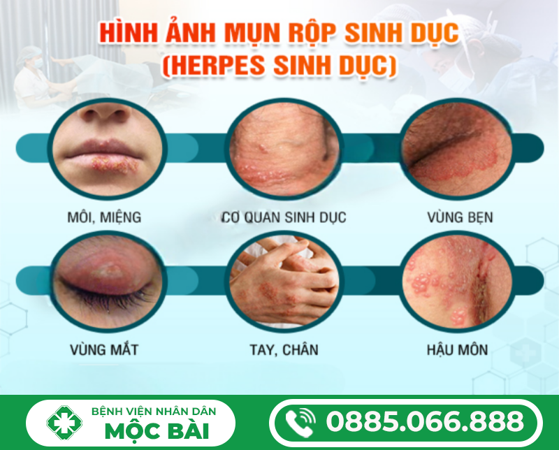 MỌC MỤN RỘP Ở BAO QUY ĐẦU