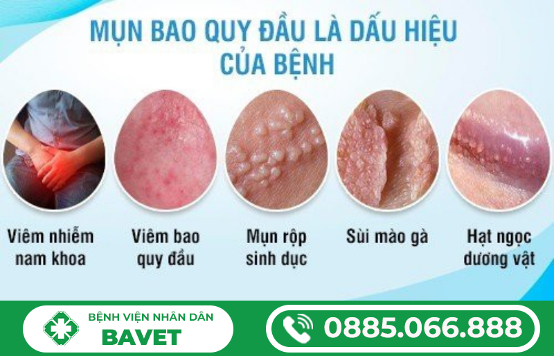 CÁCH CHỮA NỔI MỤN Ở BAO QUY ĐẦU