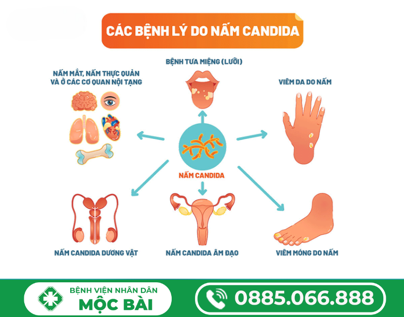 TÌM HIỂU NẤM PHỤ KHOA LÀ GÌ?