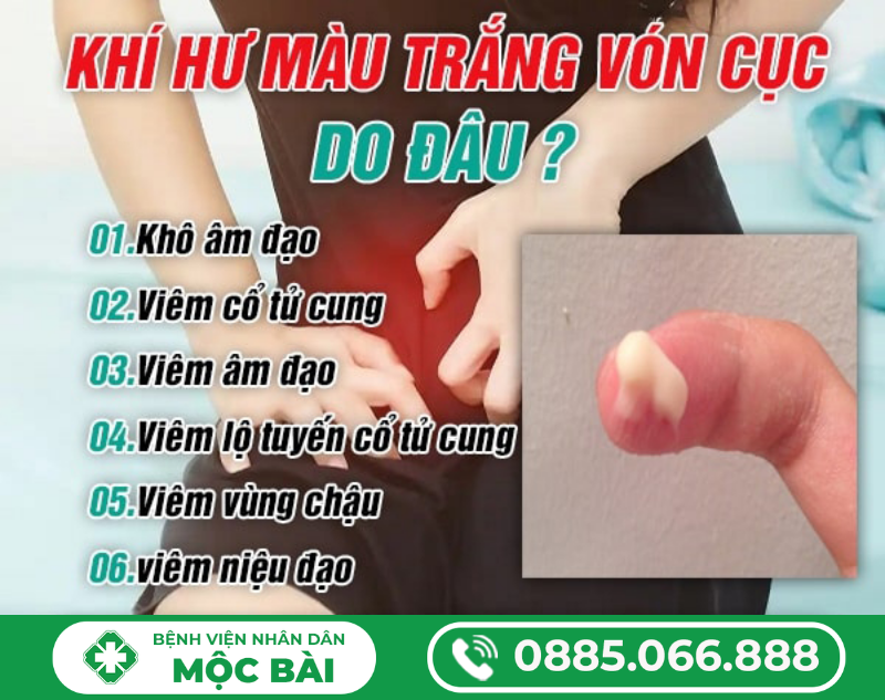 KHÍ HƯ MÀU TRẮNG VÓN CỤC LÀ DẤU HIỆU GÌ?