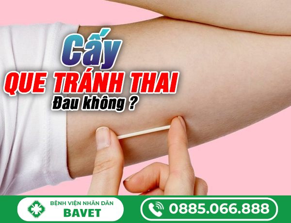 CẤY QUE TRÁNH THAI CÓ ĐAU KHÔNG?