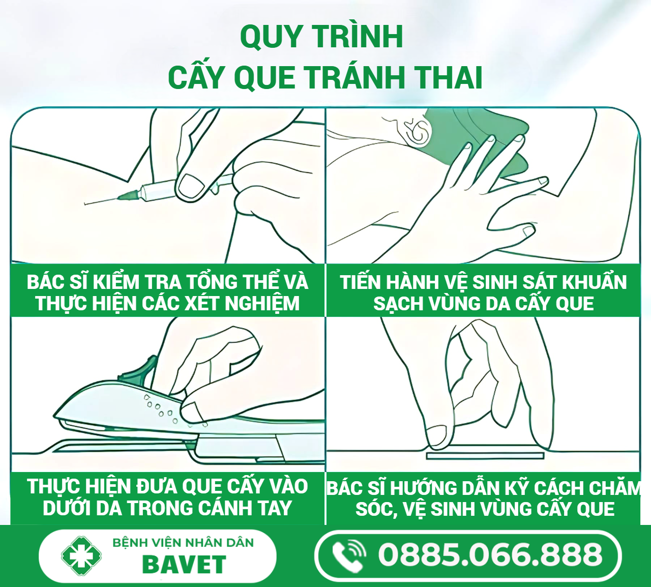 CẤY QUE TRÁNH THAI: BIỆN PHÁP TRÁNH THAI HIỆU QUẢ, AN TOÀN