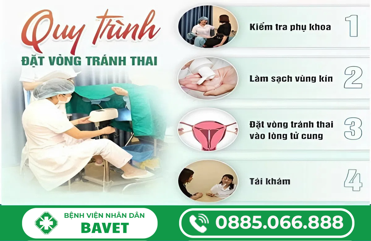 CÁCH ĐẶT VÒNG TRÁNH THAI AN TOÀN CHUẨN Y KHOA