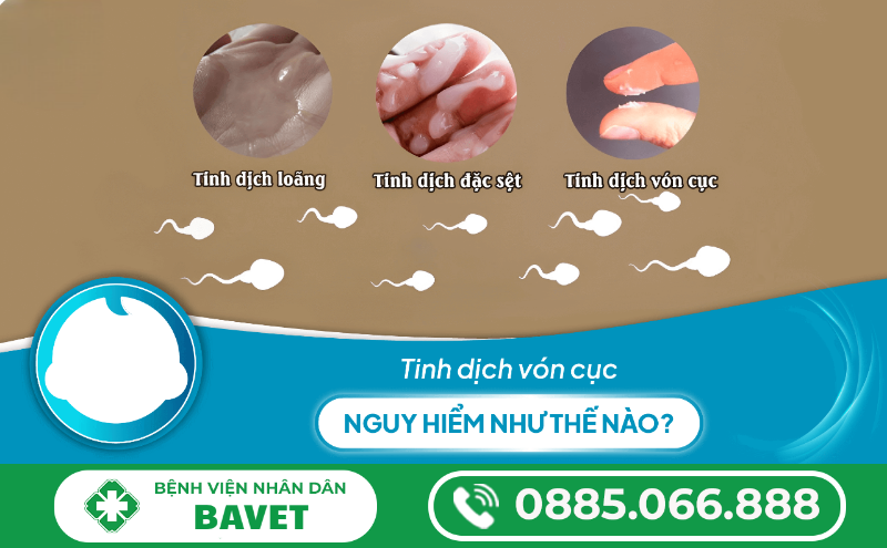TINH TRÙNG VÓN CỤC CHỮA ĐƯỢC KHÔNG?